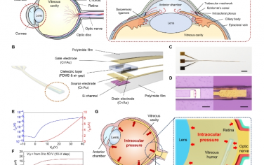 Science Advances：實時活體監測前房和玻璃體房眼壓分布以診斷青光眼